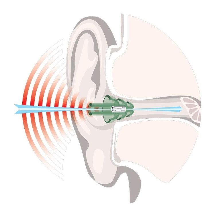 NoNoise Shooting Noise Filter Ear Protection